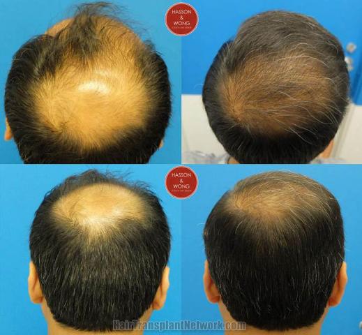 Hair restoration procedure before and after pictures