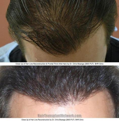 Hair transplantation surgery before and after images