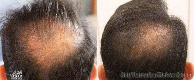 Hair transplantation surgery before and after pictures