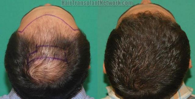 Surgical hair transplantation result photographs