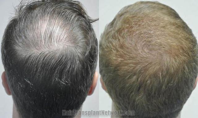 Hair transplantation surgery before and after pictures