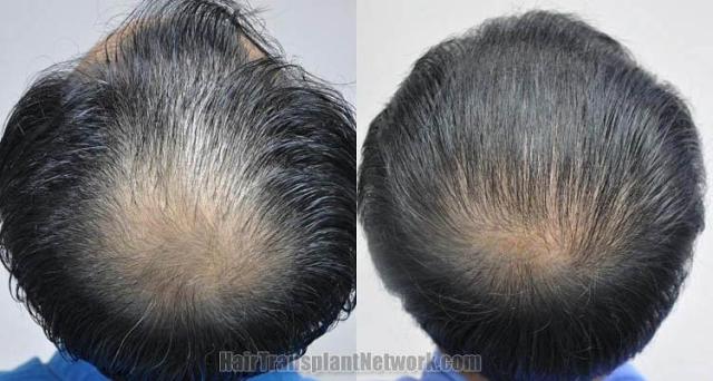 Hair restoration procedure before and after pictures