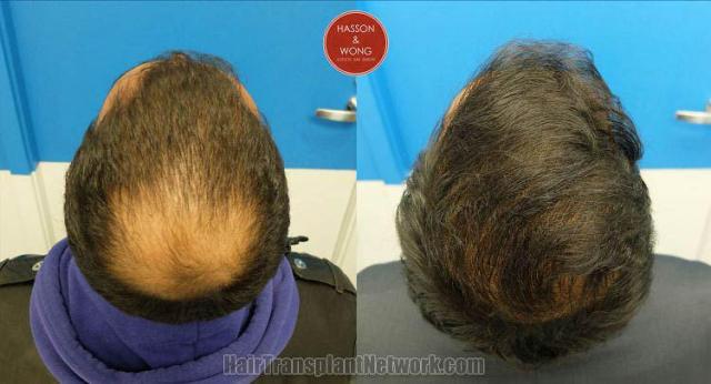 Hair restoration procedure before and after pictures