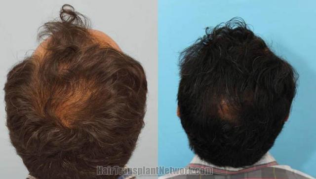 Hair restoration procedure before and after pictures