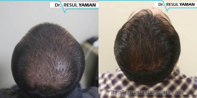 Hair restoration procedure before and after pictures