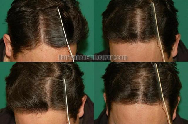 Hair restoration procedure before and after pictures