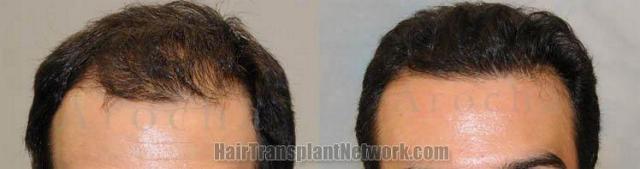 Hair restoration before and after photos