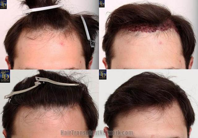 Before and after hair transplant procedure images