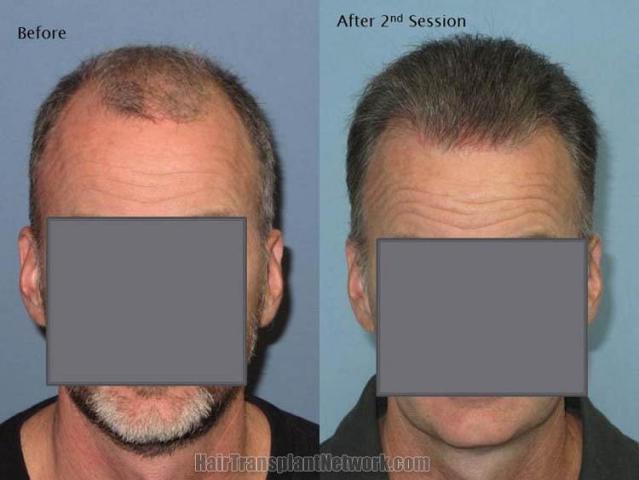 Hair restoration procedure before and after results