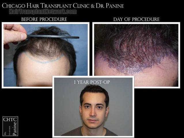 Before and after hair transplant procedure images