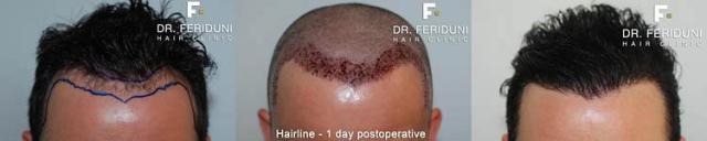 Hair restoration procedure before and after results