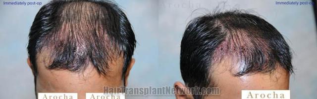 Hair restoration procedure before and after pictures