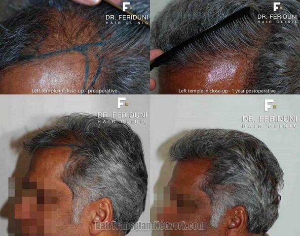 Left view before and after hair restoration procedure