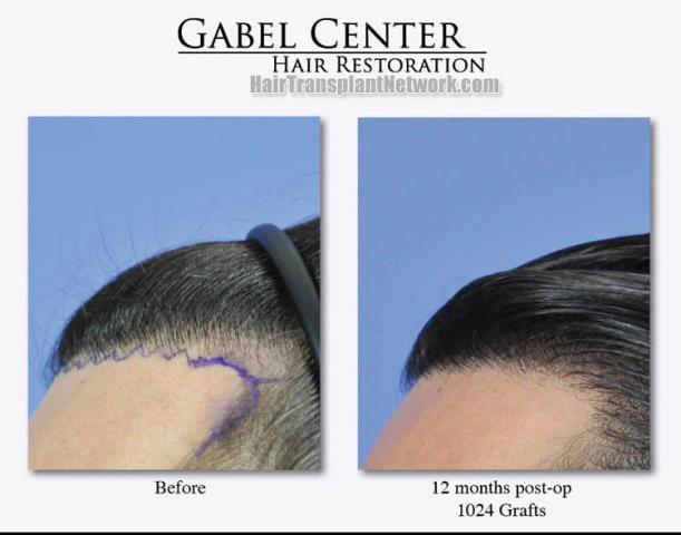 Hair transplantation surgery before and after photos