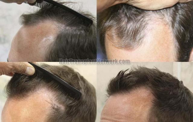 Hair transplantation surgery before and after images