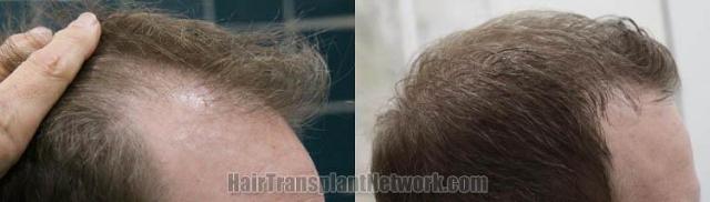 Hair transplantation surgery before and after images