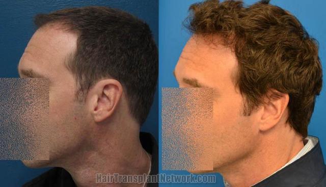 Hair restoration procedure before and after pictures