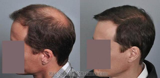 Hair transplantation surgery before and after photos