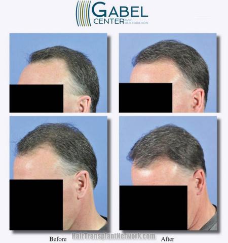 Hair transplantation surgery before and after pictures