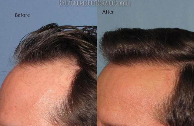 Hair transplantation surgery before and after pictures