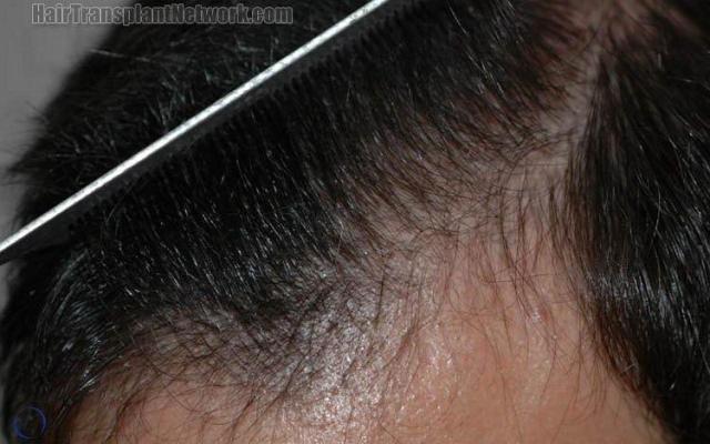 Hair restoration procedure results