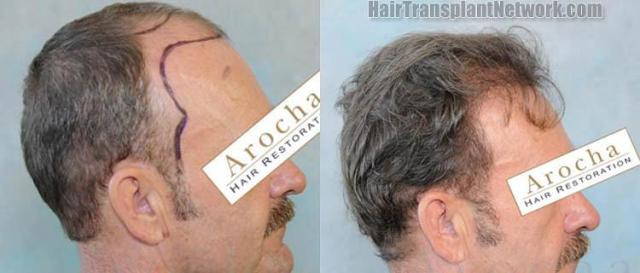 Hair transplantation surgery before and after photos