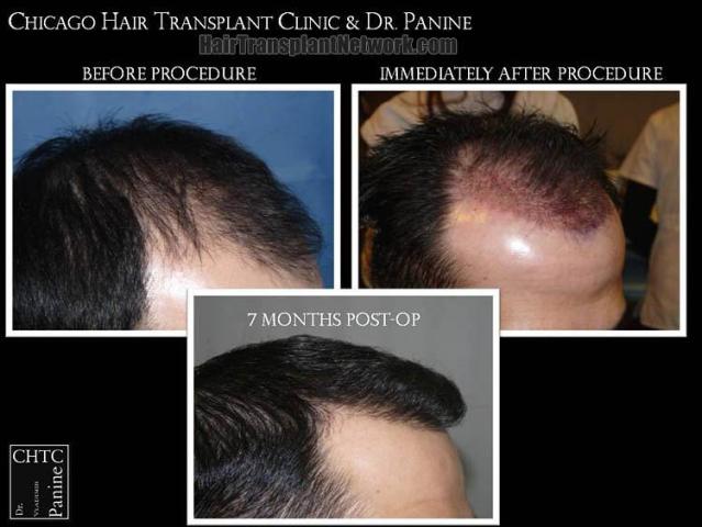 Hair transplantation surgery before and after images