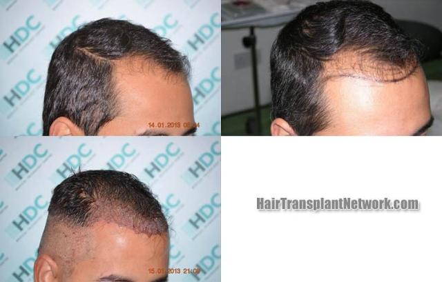 Hair transplantation surgery before and after images