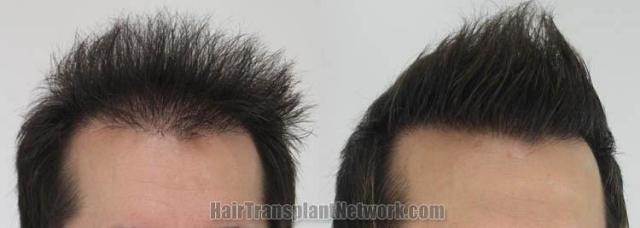 Hair restoration procedure before and after pictures