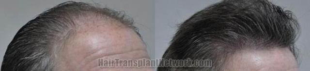 Hair transplantation surgery before and after images