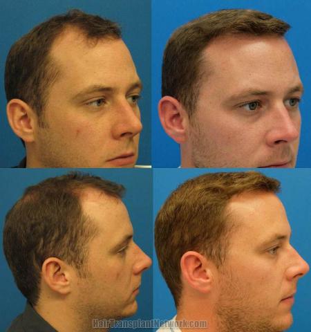 Hair transplantation surgery before and after photos