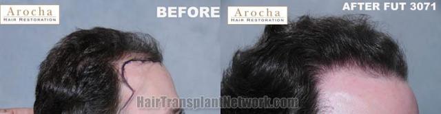 Hair transplantation surgery before and after images