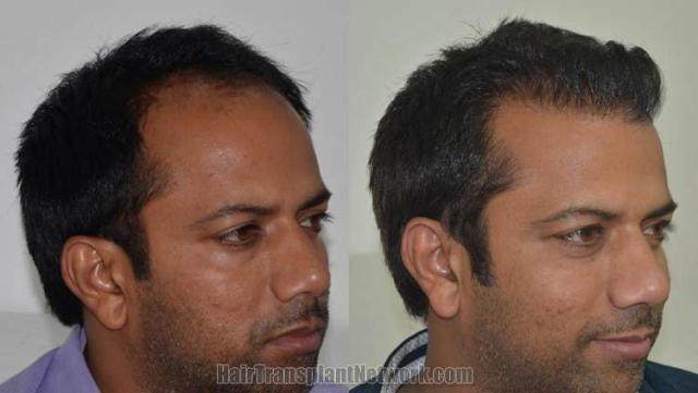 Hair transplantation surgery before and after photos