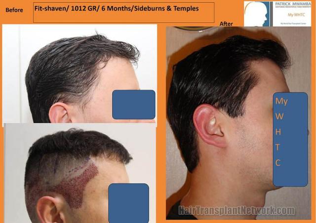 Hair restoration surgery before and after images