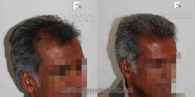 Hair transplant surgery results photos right oblique view