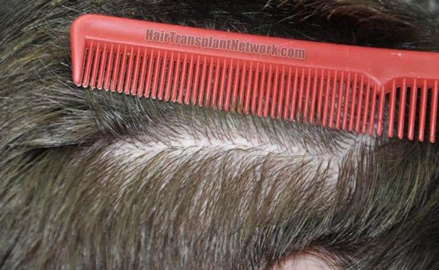 Hair transplantation surgery before and after images