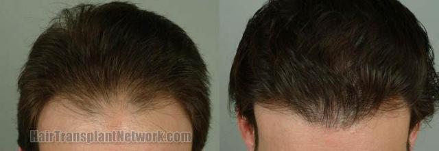 Hair transplantation surgery before and after images