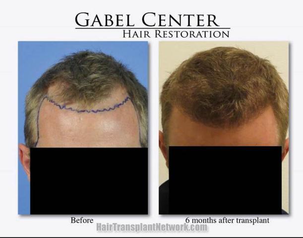 Hair restoration procedure before and after pictures