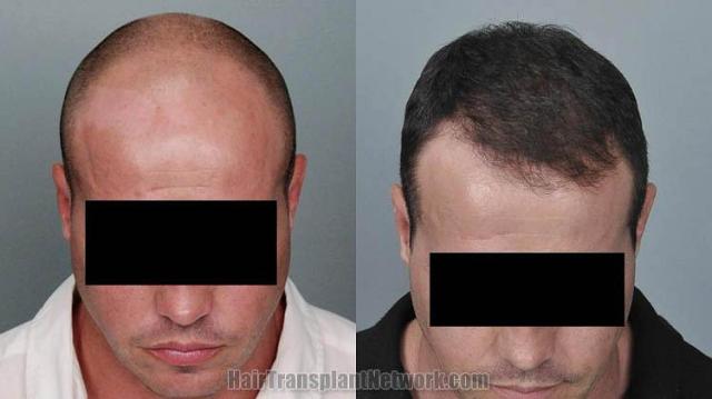 Hair restoration surgery before and after photos