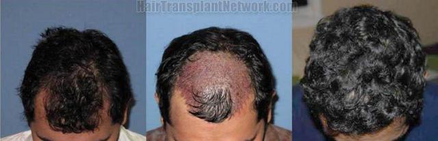 Hair restoration before and after pictures - Top view