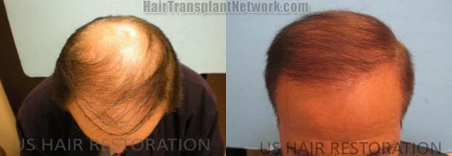 Hair restoration procedure before and after results