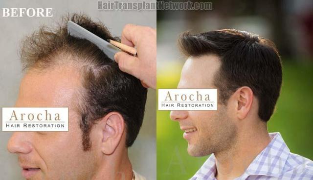 Hair transplantation surgery before and after pictures