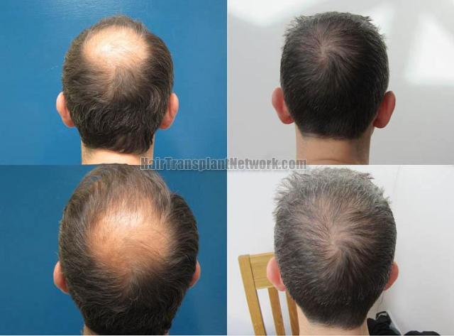 Hair restoration procedure before and after pictures