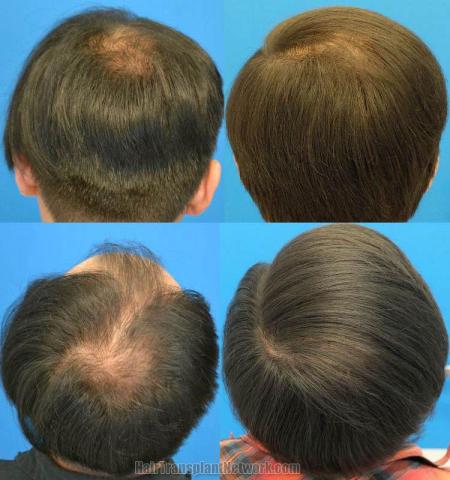 Hair transplantation surgery before and after photos