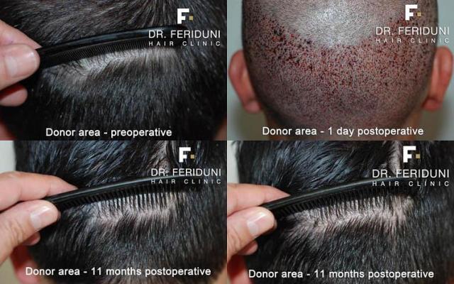 Hair transplantation surgery before and after pictures