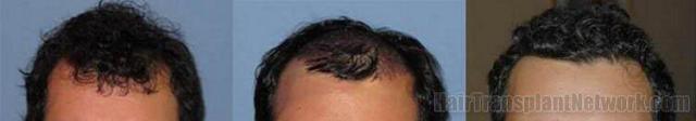 Hair transplant before and after photos - Front view