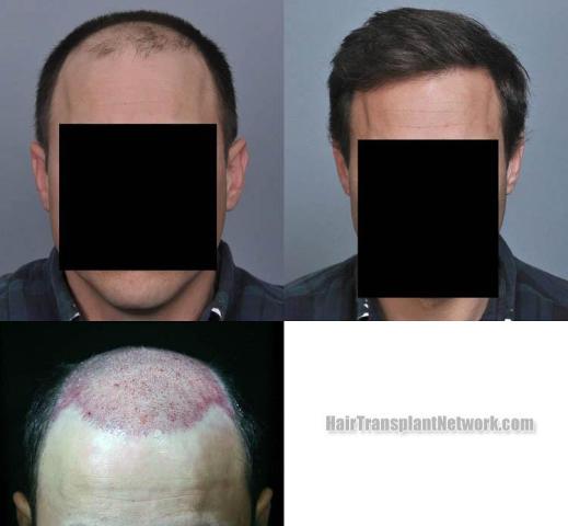 Hair transplantation surgery before and after pictures