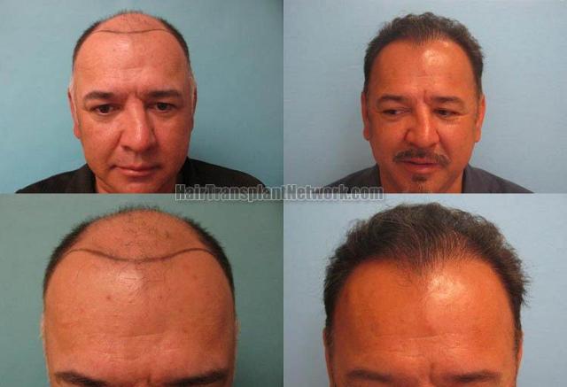 Hair transplantation surgery before and after photos