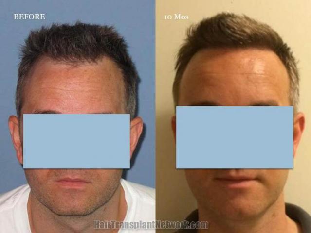 Hair restoration procedure before and after results