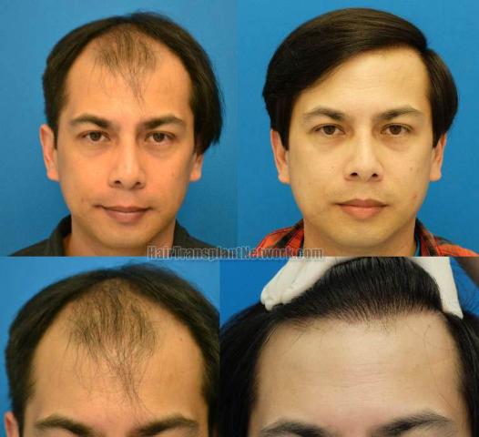 Before and after surgical hair restoration images